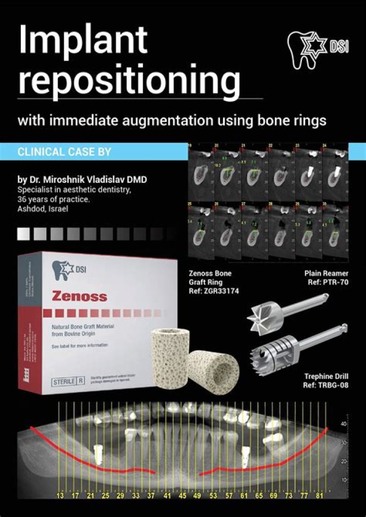 What implants does Dr miroshnik use?