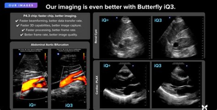 What is a butterfly ultrasound?
