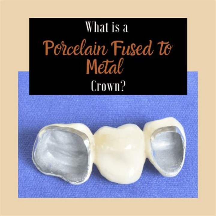 What is a crown porcelain fused to noble metal?