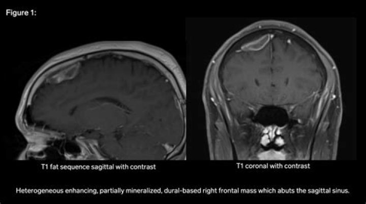 What is a dural based mass?