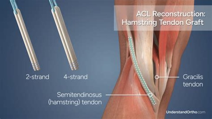 What is a hamstring graft?