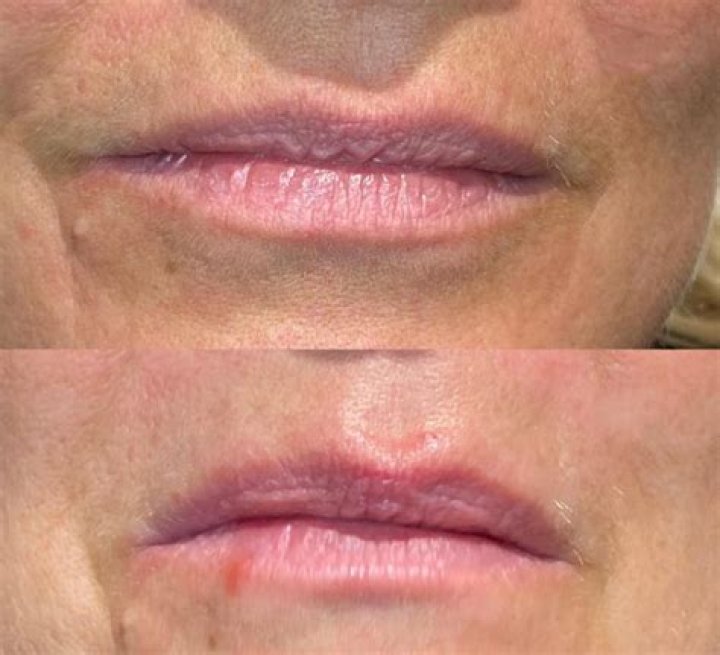 What is a lip flip treatment?