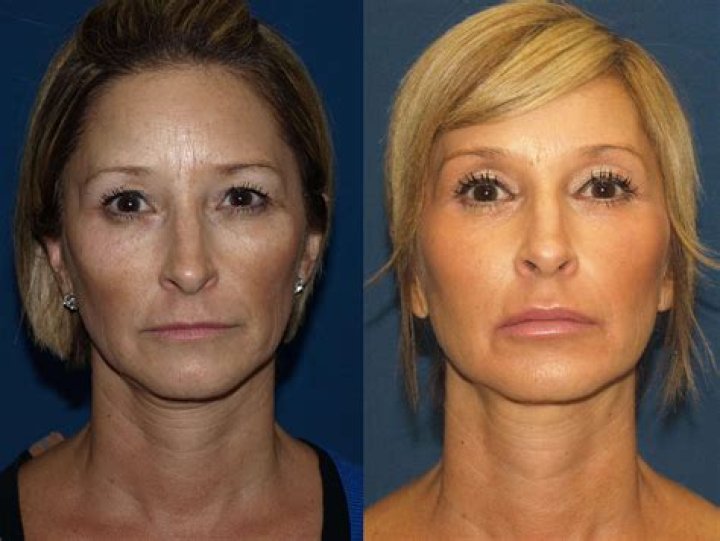 What is a liquid facelift?