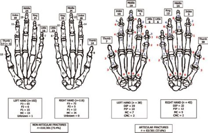 What is a P1 fracture?