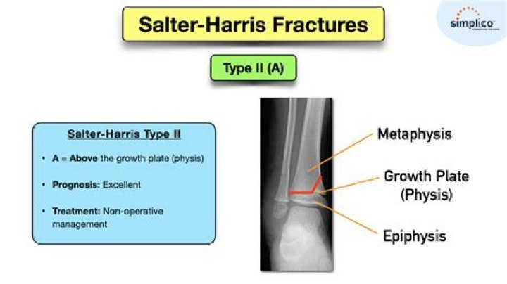 What is a Salter 2 fracture?