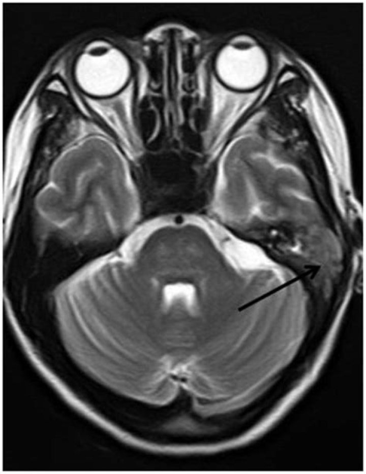 What is a t2 hyperintense mass?