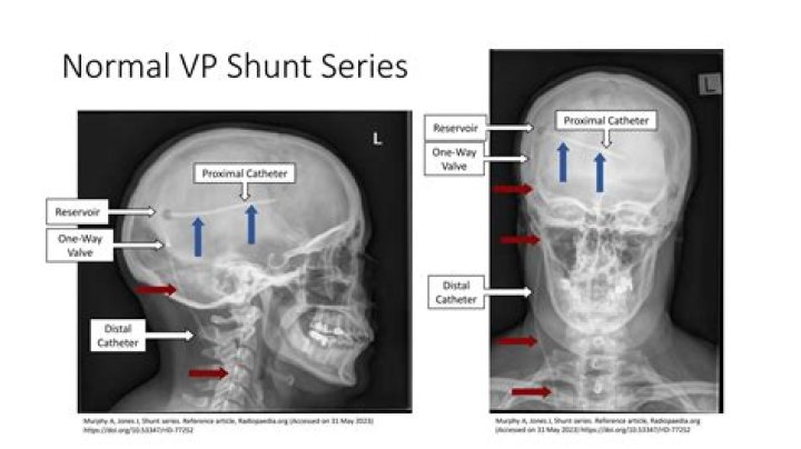 What is a VP shunt series?