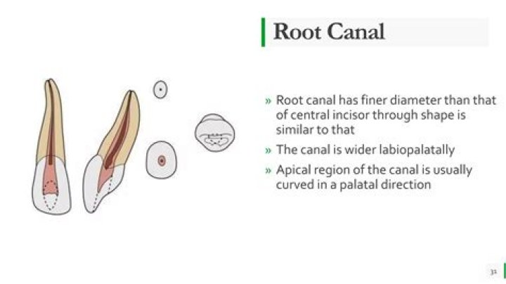 What is AC shaped root canal?