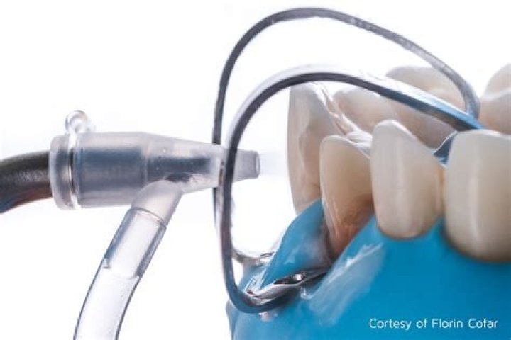 What is air abrasion in dentistry?
