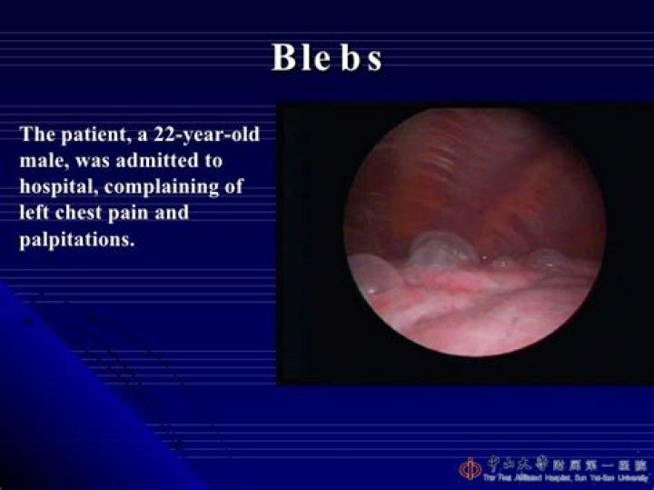 What is an apical bleb?