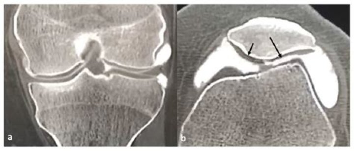 What is an articular cartilage defect?
