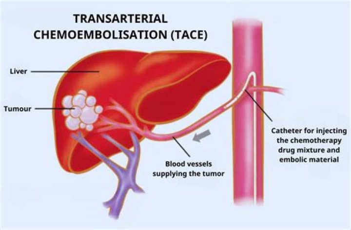 What is bland embolization of the liver?