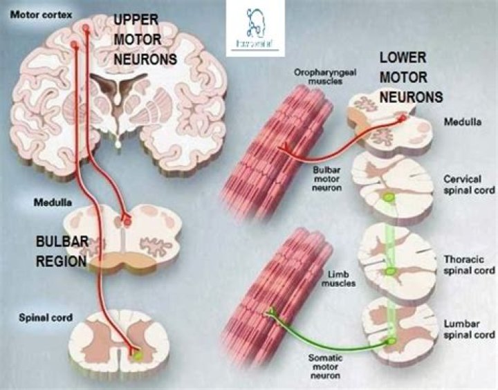 What is bulbar motor neuron disease?
