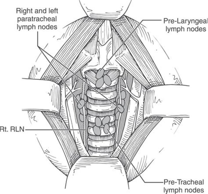 What is central lymph node dissection?