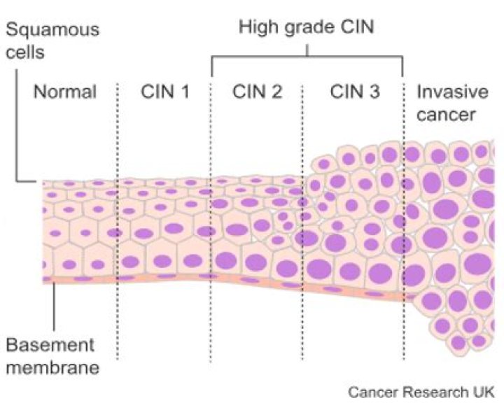 What is CIN 2 and how should it be treated?