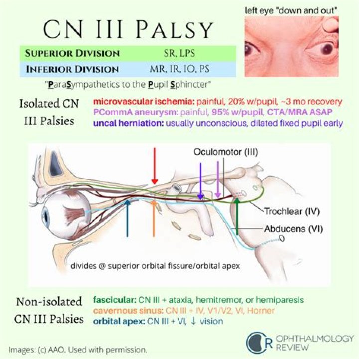 What is cranial nerve 3 palsy?