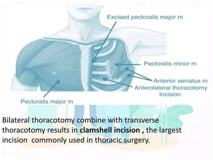 What is finger Thoracostomy?