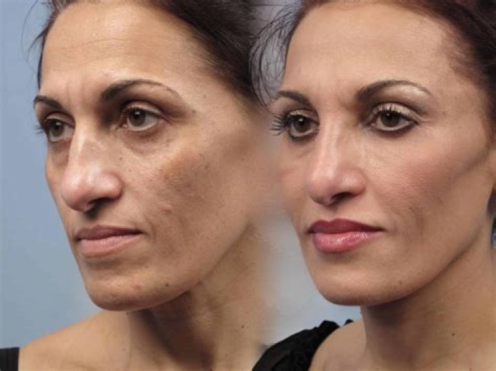 What is Fractional Erbium laser?