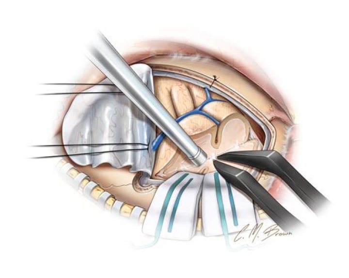 What is frontal lobectomy?
