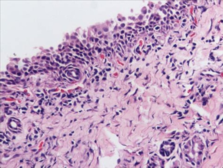 What is Lymphoplasmacytic rhinitis?