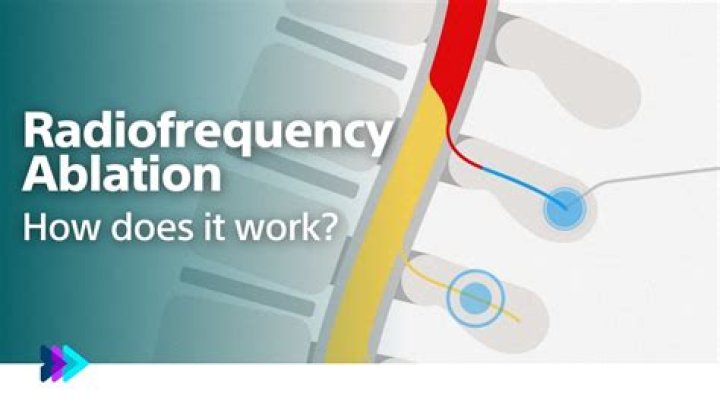 What is pulsed radiofrequency ablation?