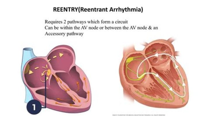What is reentry arrhythmia?