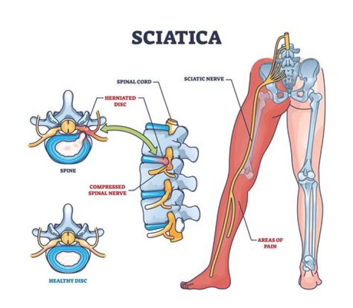 What is sciatic fibrosis?