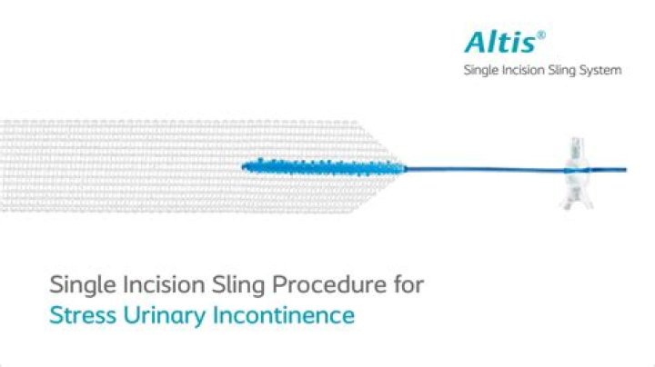 What is sling operation for stress incontinence?