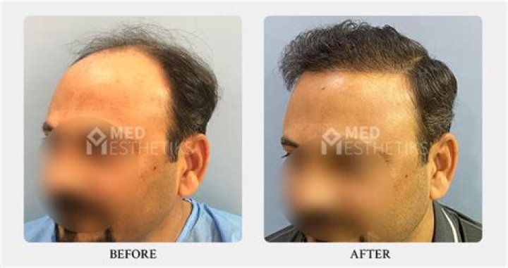 What is the best age to get hair transplant?
