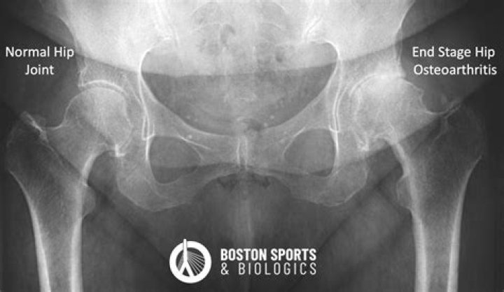 What is the best imaging for osteoarthritis?