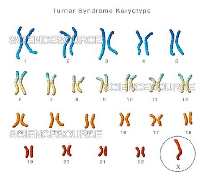 What is the correct notation for patient A's karyotype?