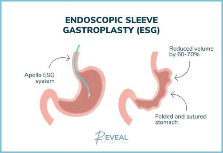What is the CPT code for endoscopic sleeve gastroplasty?