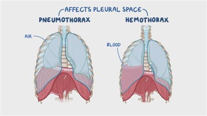 What is the difference between a pneumothorax and a Haemothorax?