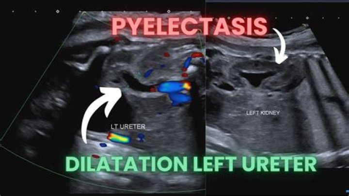 What is the ICD-10 code for fetal Pyelectasis?