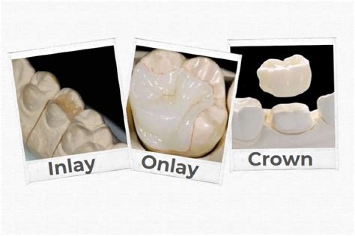 What is the material of choice for an inlay or onlay restoration?