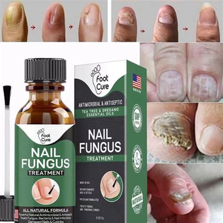 What is the most effective treatment for finger nail fungus?