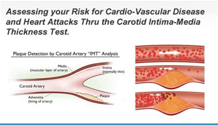 What is the normal carotid intima media thickness?