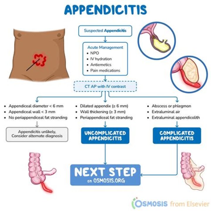 What is the pathophysiology of acute appendicitis?