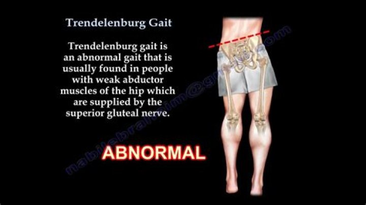What is the Trendelenburg gait?