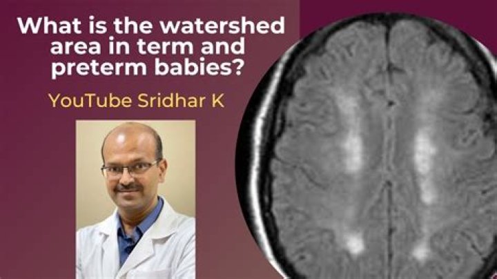 What is the watershed region of the brain?