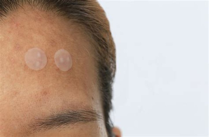 What is the white stuff on pimple patches?