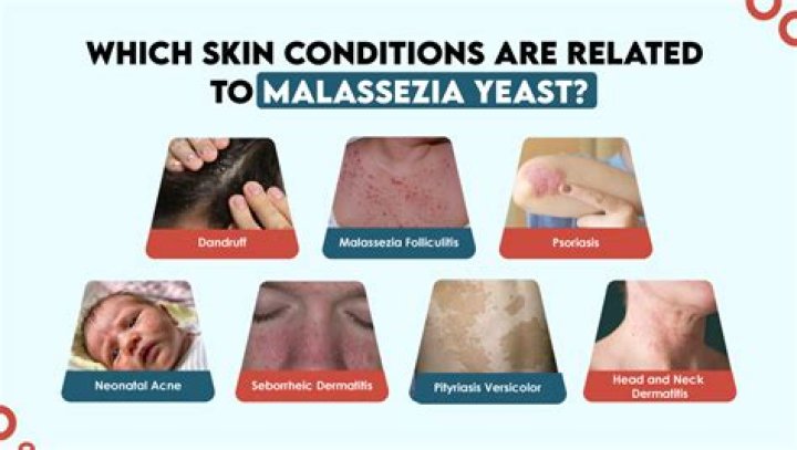 What kills Malassezia yeast on face?