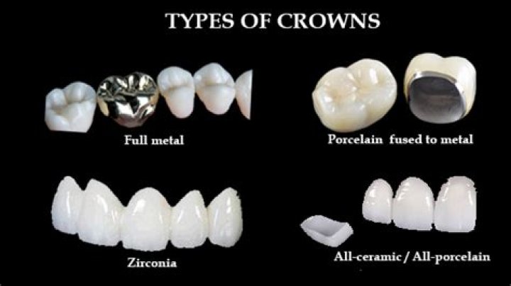 What material are are crowns made from?