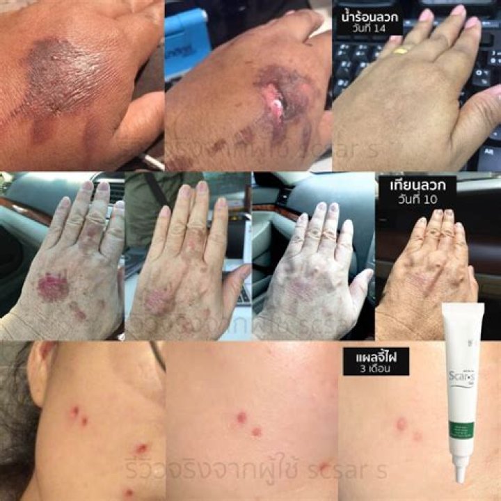 What prevents scarring?