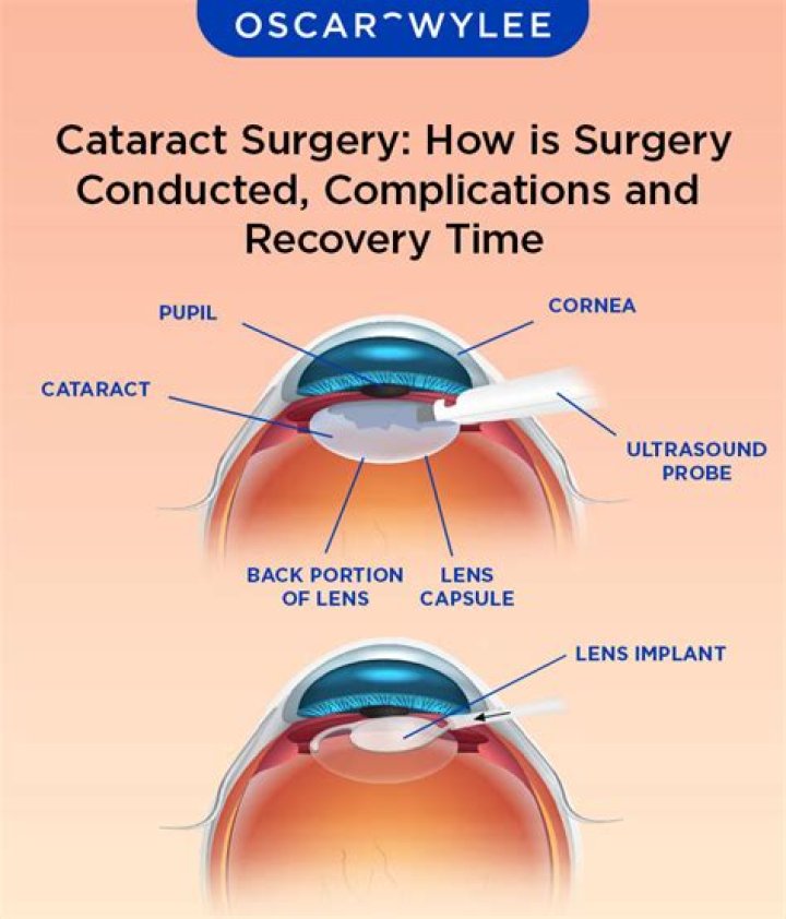 What should be the sugar level for cataract operation?