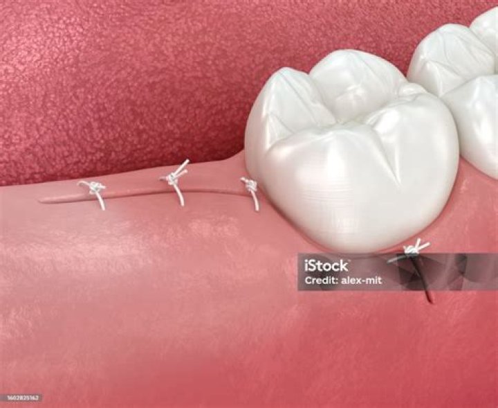 What stitches are used for wisdom teeth?