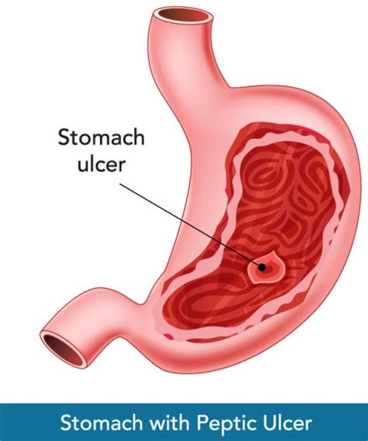 What to do if you have a bleeding stomach ulcer?