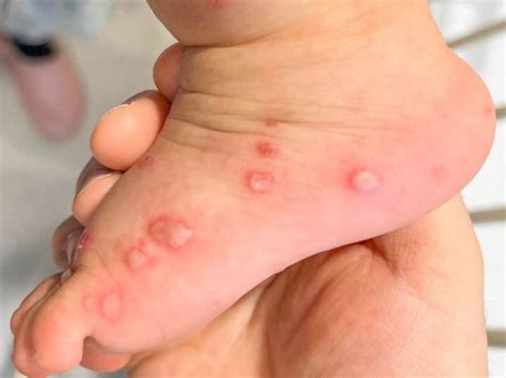 What type of virus is hand foot and mouth?