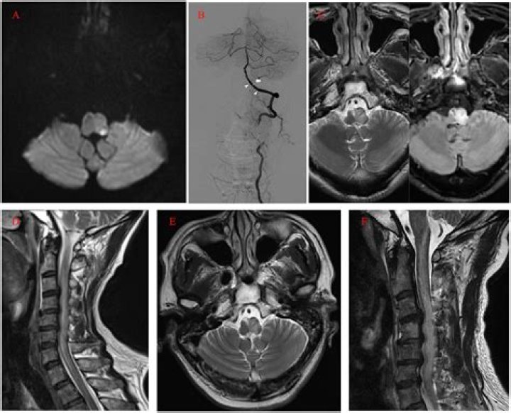 What will happen if medulla is damaged?