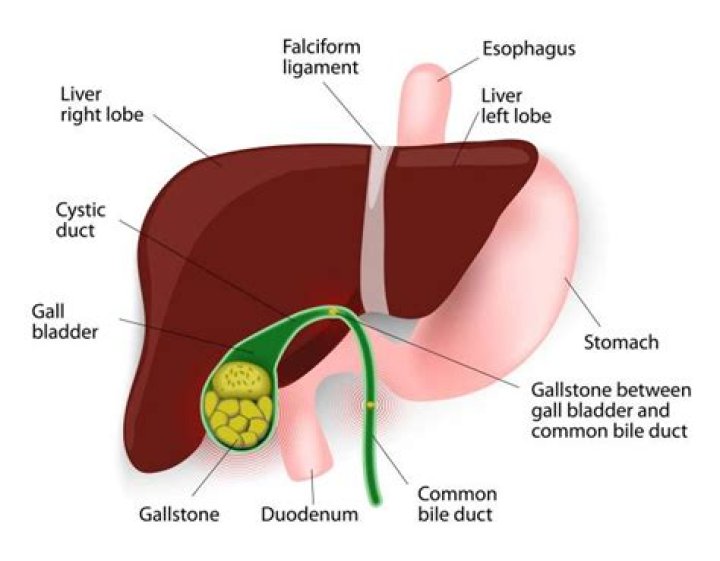 Where do gallstones go?